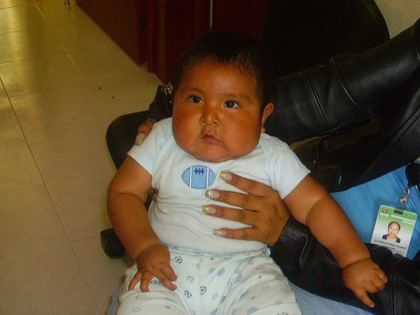 obesidad