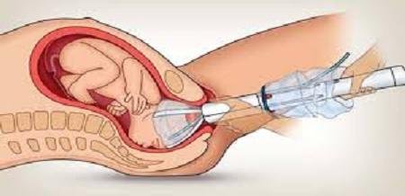 Invención de mecánico salvará centenares de vidas de recién nacidos