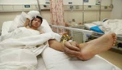 hino vivió un mes con su mano implantada en el tobillo