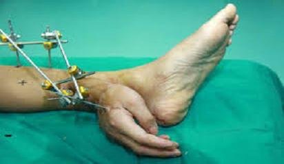 hino vivió un mes con su mano implantada en el tobillo2