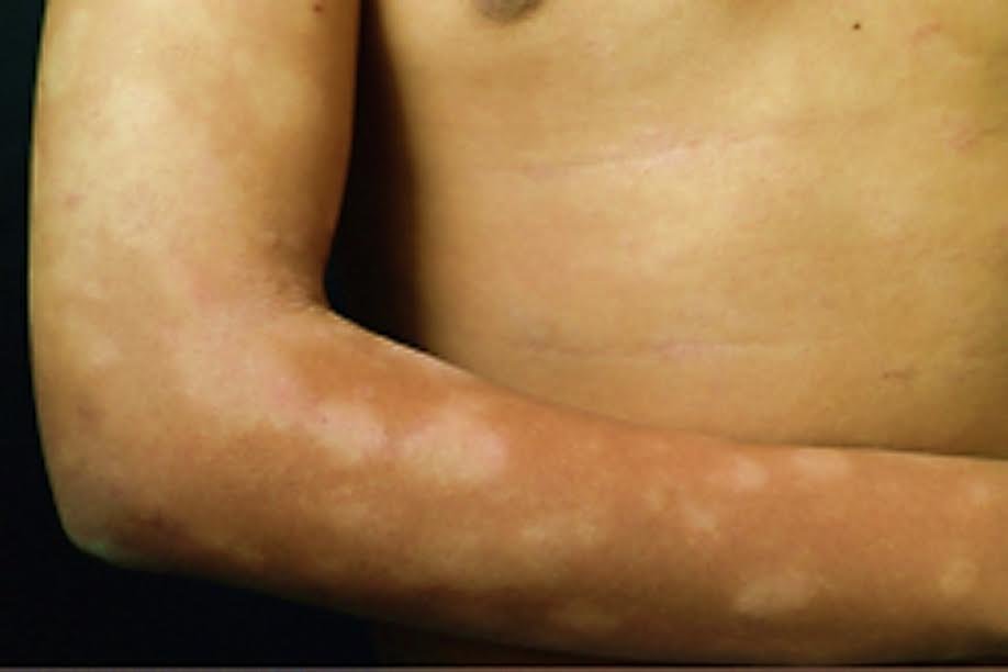 EL “DÍA MUNDIAL DE LA LUCHA CONTRA LA LEPRA”