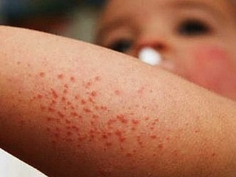 Cierran 12 escuelas en Oaxaca por virus coxsackie