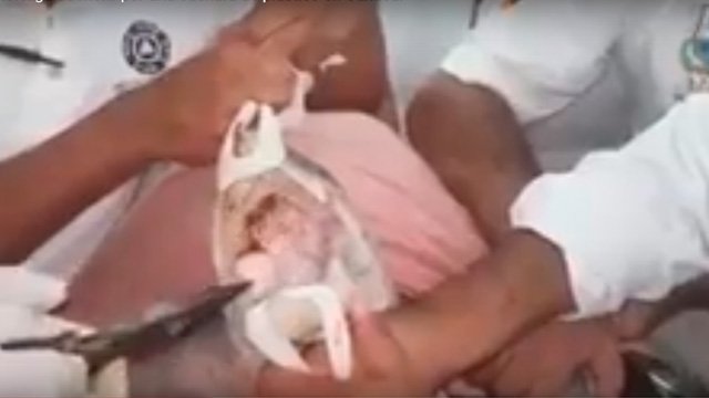 Salvan a tortuga de morir por una cuchara de plástico en Puerto Escondido