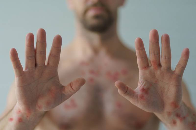 Gobierno de Oaxaca mantiene activo protocolo de seguridad por Viruela Símica